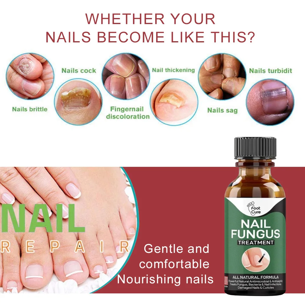 Nail Fungus treatment 10ml foot cure