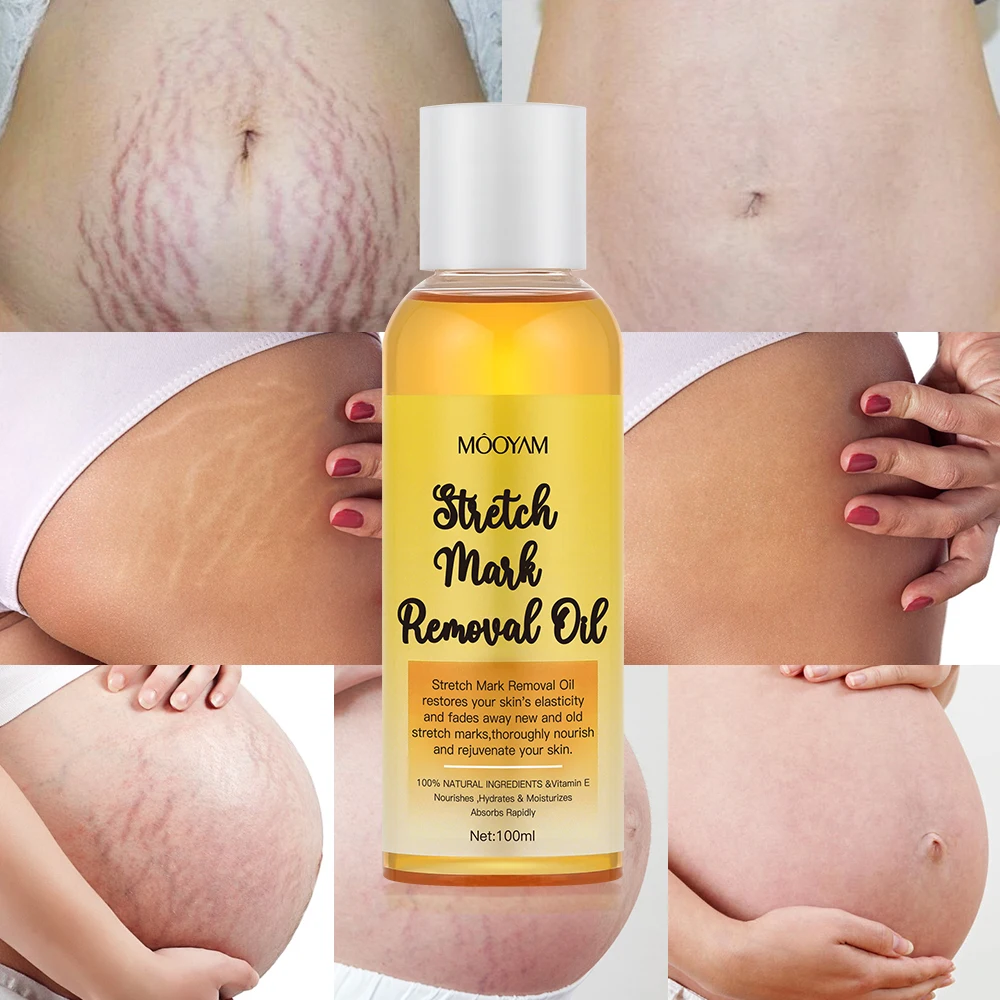 Long-lasting Moisturizing Improve Roughness and Lighten Stretch Marks Gentle Nourishment 100ml MOOYAM Stretch Marks Removal Oil