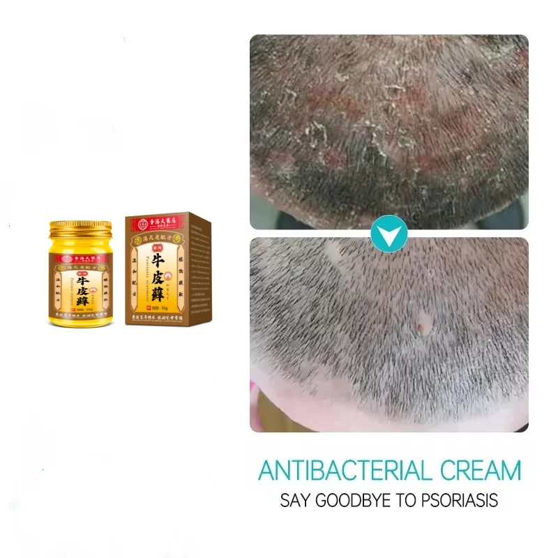 Psoriasis Cream Eczema Natural Herbal  Per Cure Scalp Dry Skin Care Products Against Psoriasis Ointment 50g
