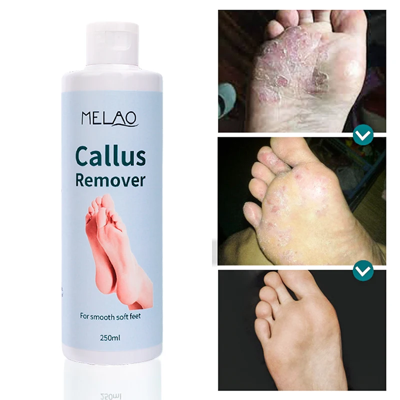MELAO Cracked Heel Repair Tough Callus Remover Gel Callus Remover For Feet