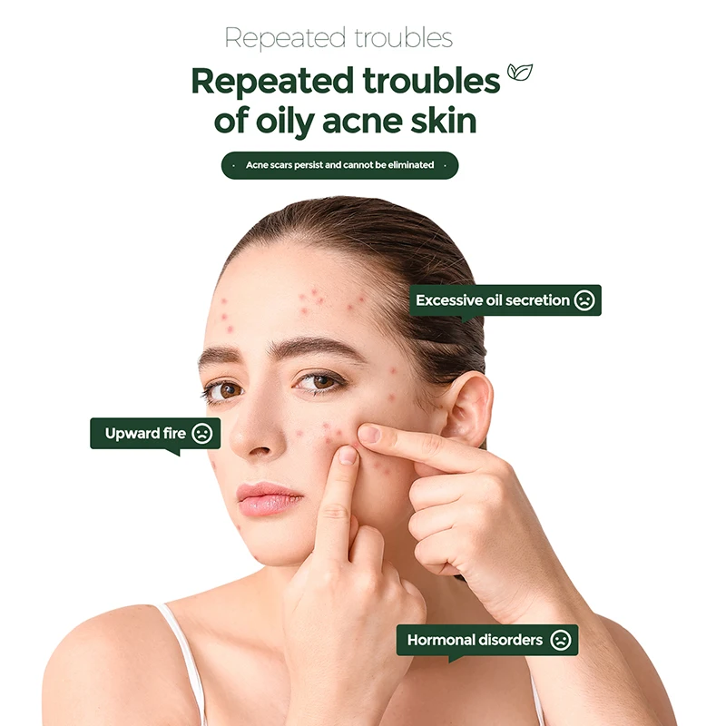 anti effective treatment face for pimples 12 hour 5 day acid ccar removal and whitening clearing gel control acne cream acnes