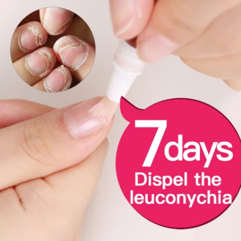 Nail Fungus Repair Treatment Pen Products Onychomycosis Paronychia Anti Fungal Nail Infection Chinese Herbal Care Oil Pen