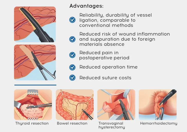 vessel sealing advantage.png