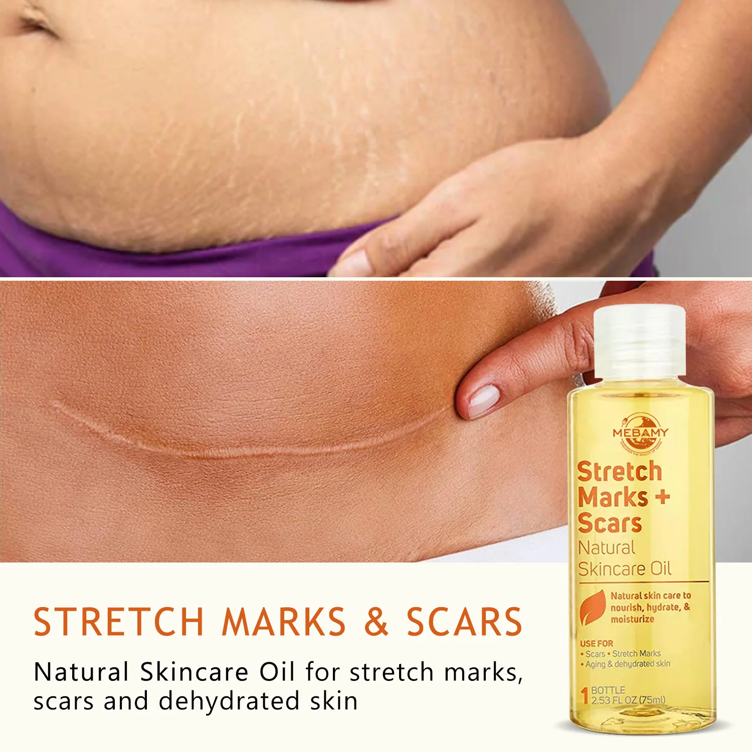 Best Sell Body Pregnancy Stretch Marks Removal Oil For Stretch Marks Anti Stretch Marks Oil Skin Care Repair Scar Removal Oil