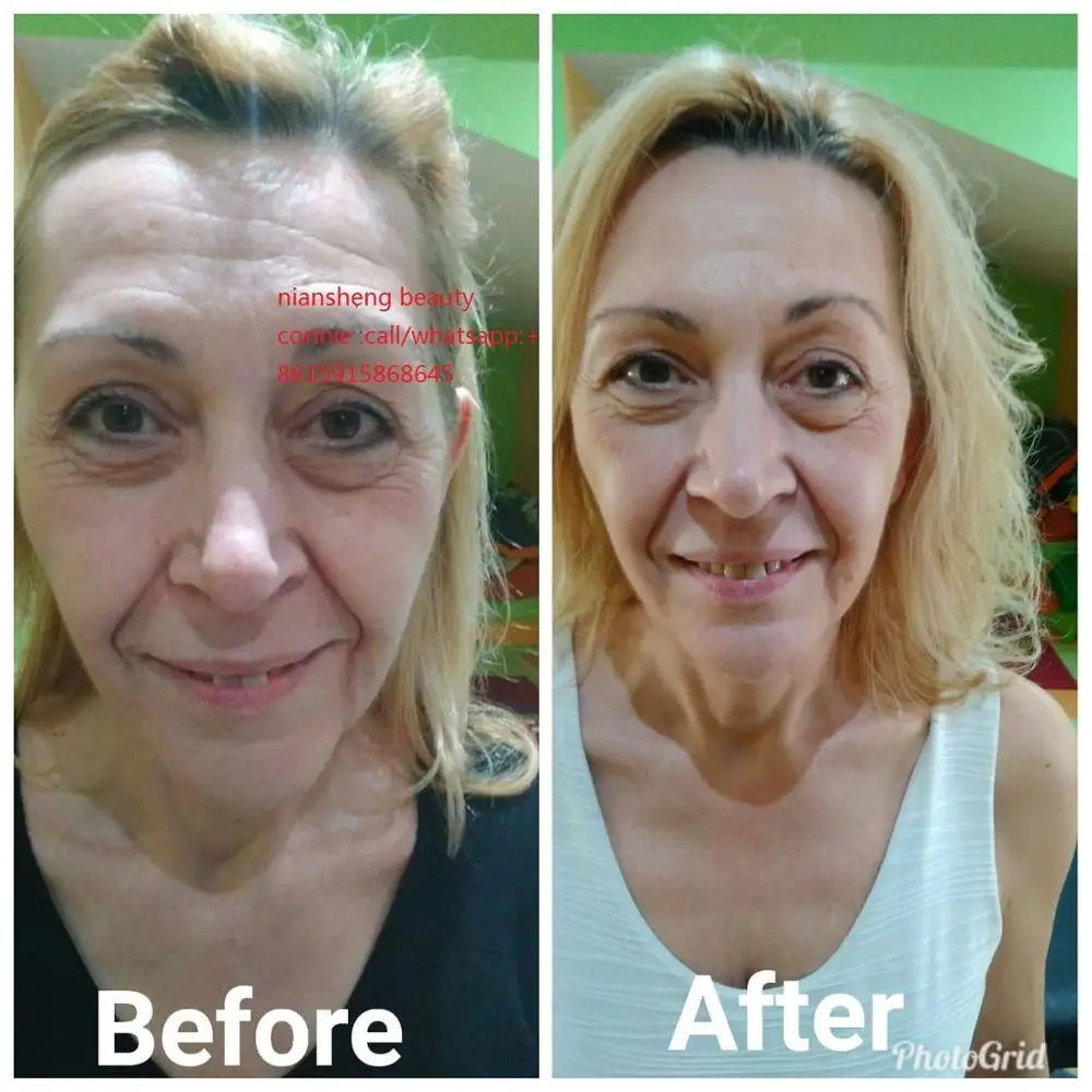 Multifunction 4 in 1 OPT  + Elight + RF + ND YAG Laser 4 In 1 Multifunction Facial Skin Care Beauty Machine