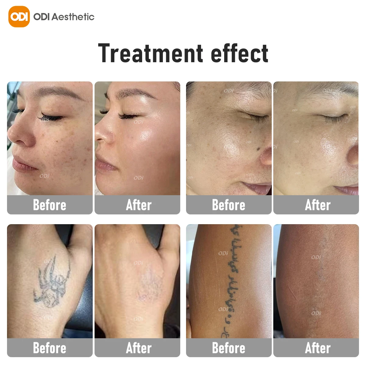 Pico Laser Machine Nd Yag Laser Pigment Therapy Machine Pico Laser Tattoo Remover Portable