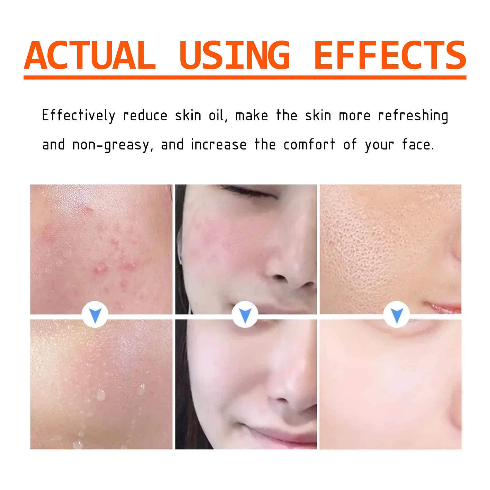Hot Selling Acne Removal Cream Herbal Acne Spots Oil Control Acne Cream Spot Pimples Remove BHA Salicylic Acid Facial Cream