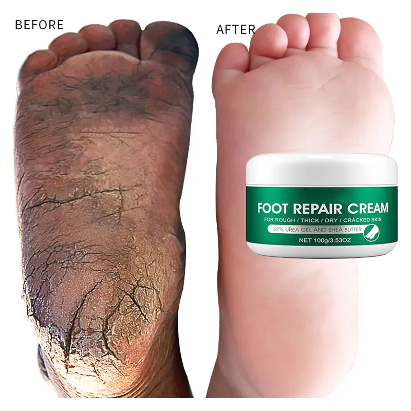 Anti Fungal Foot Repair Foot Cream Dead Skin Removal Peeling Moisturizing Exfoliation Foot Care Repair Cream For Cracked Heels