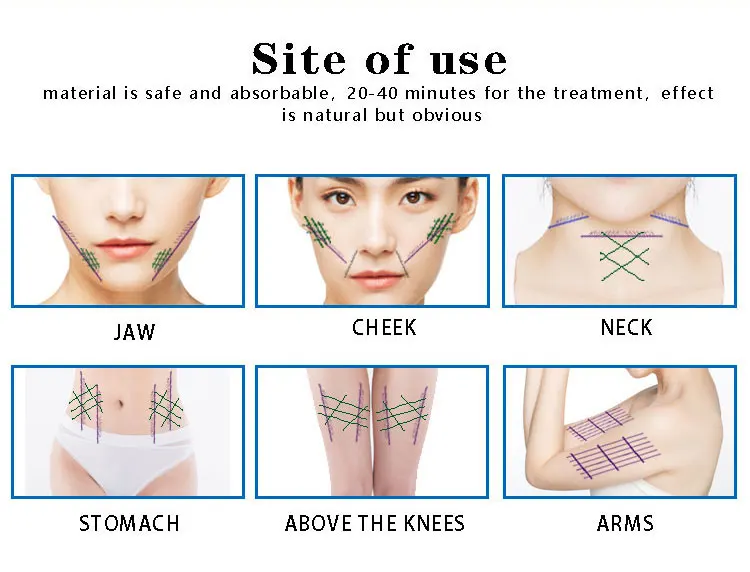 
Face Lifting Thread PLLA Mono Thread 30g 38mm With Needle 