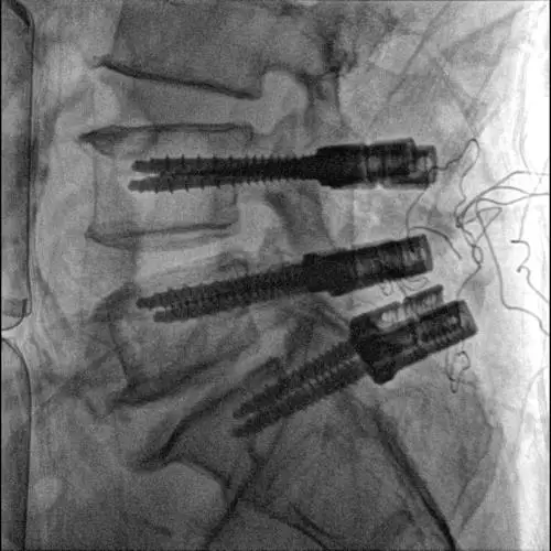 Advanced Mobile C arm x ray system with dual touch control