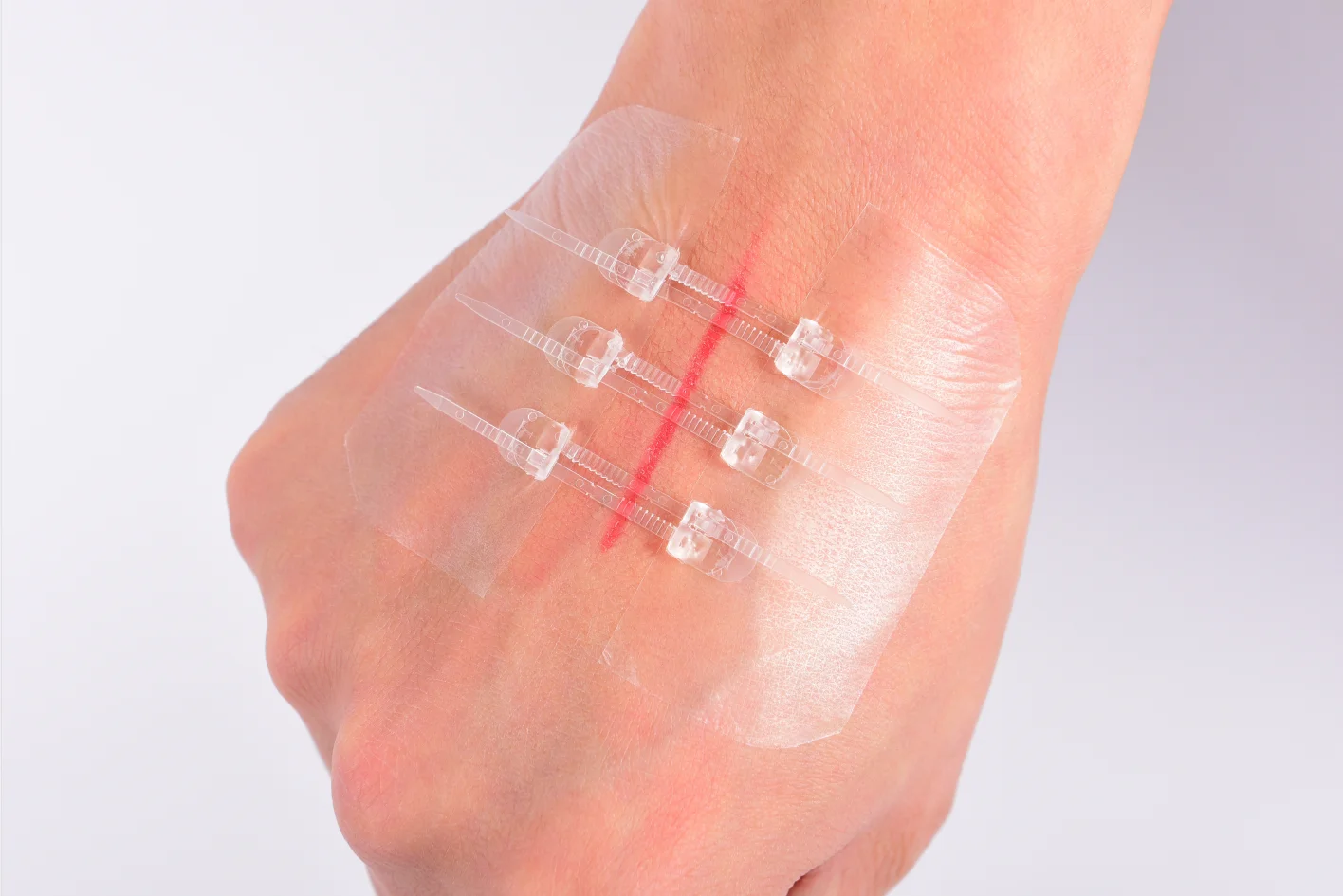 Medical Sterile Skin Closure Device Noninvasive Zip Without Stitches Sterile Strips Without Threads Dressing Wound Closure Strip