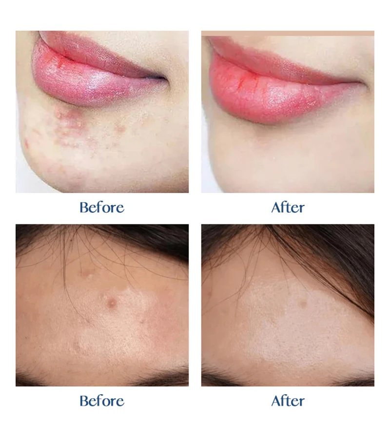 Custom Invisible Skin Micro Needle Pimple Acne Healing Patch Micro-needle Acne Patch Spot Treatment for Zit and Blemish