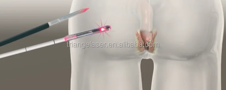 New Design 980NM Anal Piles Fistula Fissure And Pilonidal Sinus Laser External Hemorrhoid Treatment