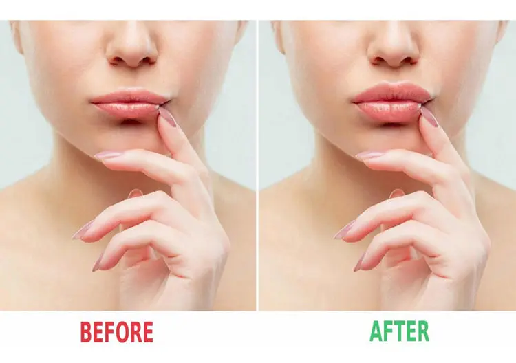 2022 Hot selling faden ifting absorbable PDO korea thread for wrinkles between Eyebrows eye bags 18G 100MM V Shape lifting