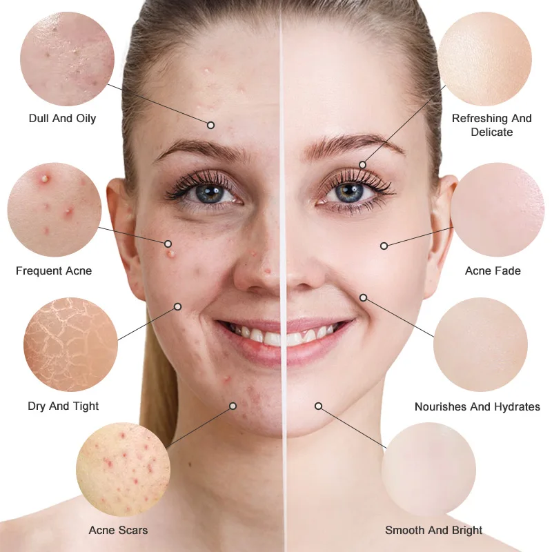 RtopR Propolis Repair Acne Brightening Serum Acne Scar Spots Cleaning Serum Shrink Pores Eliminates Acne Treatment Oil control