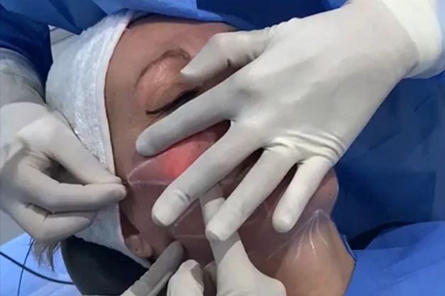 980nm 1470nm Lipolysis Diode Laser Machine Fiber Optic Facial Lifting Slimming Weight Loss Liposuction Equipment Endolaser Lift