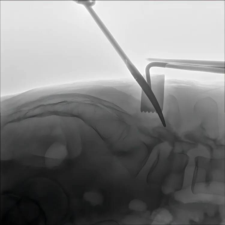 Manufacture price 5kw fluoroscopy radiology c arm x ray machine
