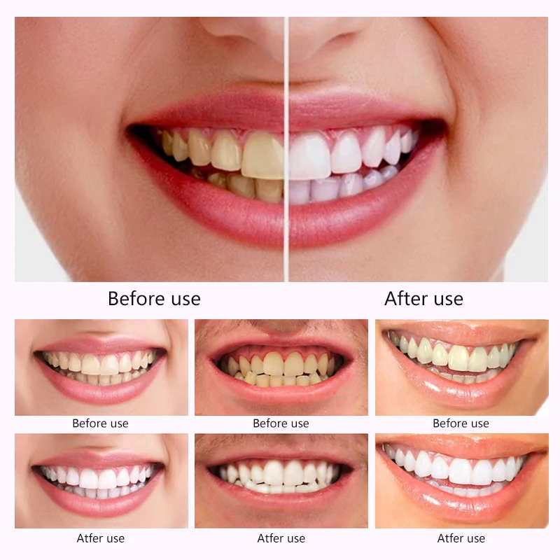 Customized Brand Teeth Whitening Strip Teeth Stain Removal Dental Bleaching Care Cleaning