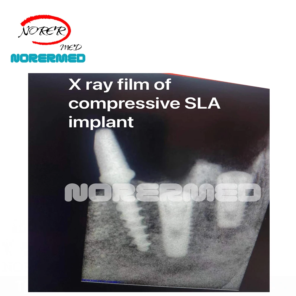 China manufacturer Titanium  Dental  TPG one-piece Implant Screw with Abutment for Dental Implant system