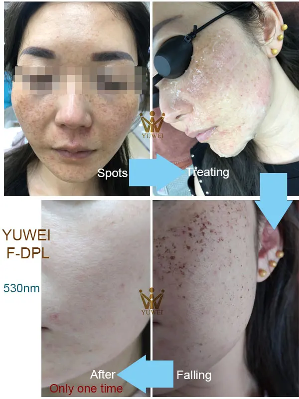 Multi-Functional Laser Hair Removal Rf Beauty Machine Ipl F-Dpl Laser Hair Removal System