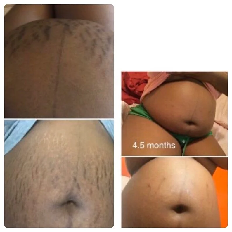 100ml Private Label Stretch Mark Scar Oil Vitamin E & Collagen Skin Firming Body Oil Stretch Mark Removal Oil