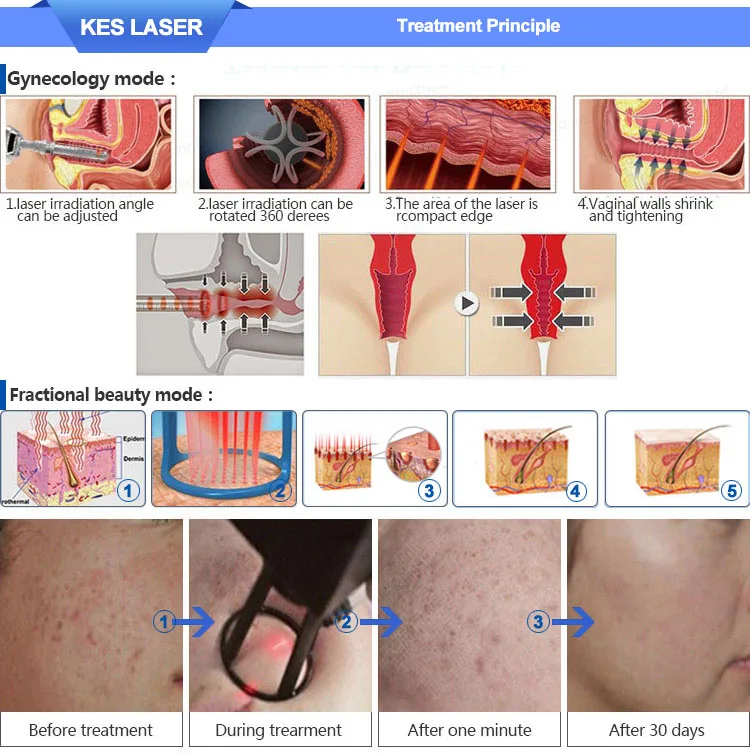 Устройство для омоложения кожи KES rf/омоложение кожи, лифтинг лица/оборудование лазера co2 Фракционный лазер co2 для омоложения кожи