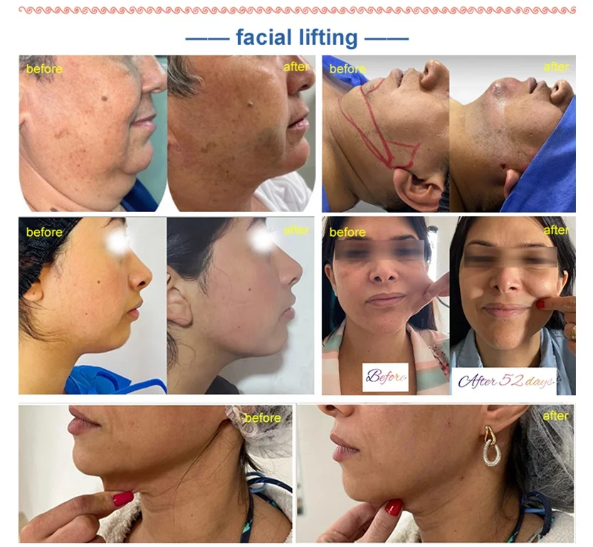 980nm High power 60w Lipolysis Laser for Fat Burning Cellulite Weight Loss