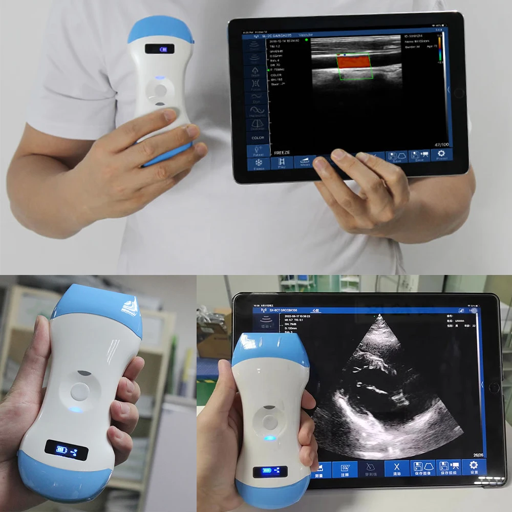 Suresult Color Doppler On-the-Go Solutions For Emergency Medicine: Portable Ultrasound With Convex Probe