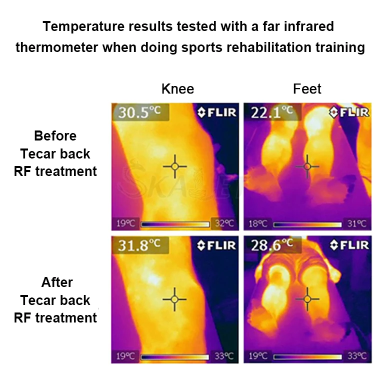 diathermy electrosurgical generator tecar therapy physiotherapy parts new tecar therapy 3 in 1 tecar rf ems