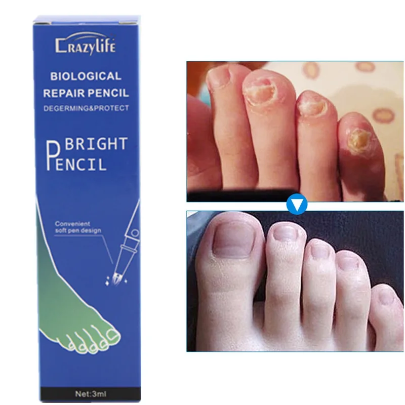 Nail Repair Anti Fungal Treatment Nail Pen Onychomycosis Paronychia Infection Toe Finger Nail Nutrition Health OEM