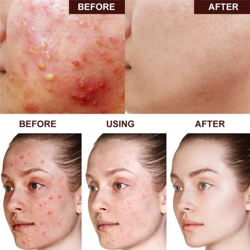 Private Label Face Zit Patch Acne Dots Hydrocolloid Invisible Acne Patch Pimple Patch