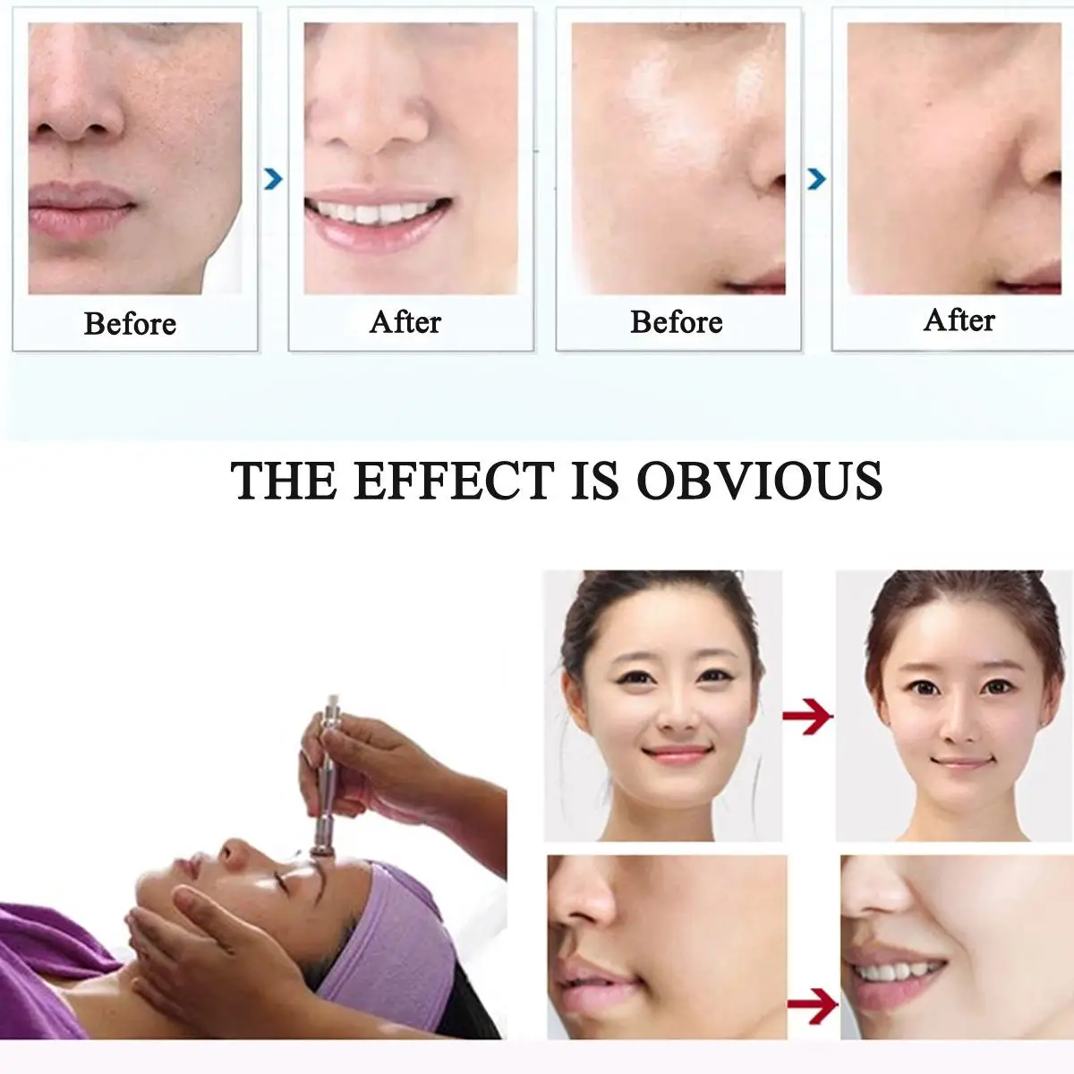 Professional Microcrystalline Dermabrasion Beauty Machine New Diamond for Face Nose Head Tightening UK Plug