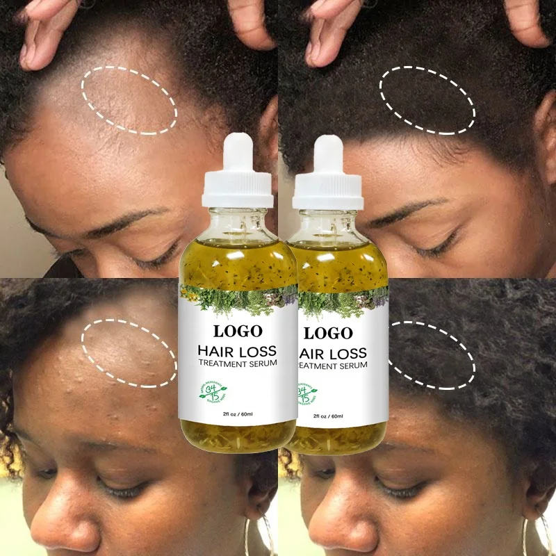 OEM Custom Private Label Natural Organic Top Grade Scalp Care Hair Care Loss Treatment Oil Hair Growth Serum