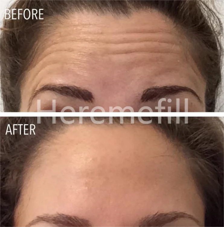Heremefill  Injecting cross-linked gel hyaluronic acid skin filling facial filler facial wrinkles