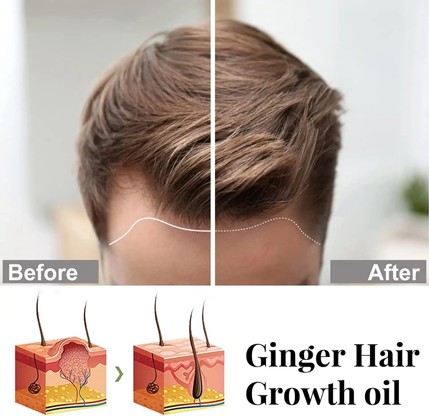 Anti Hair Loss Treatment Natural Ginger Root Melon Fast Hair Growth Serum Hair Growth Oil Serum for Men and Women