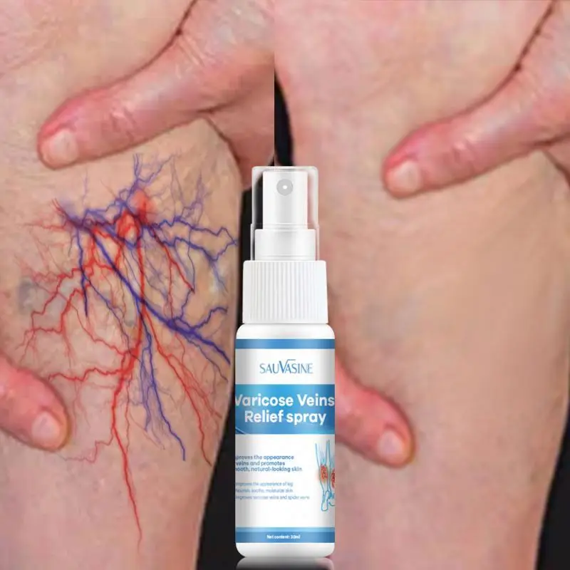 Spray Relief Phlebitis Angiitis Remedy Patch Spider Veins Edema Nerve Pain Earthworm Leg treatment cream Varicose Vein Spray