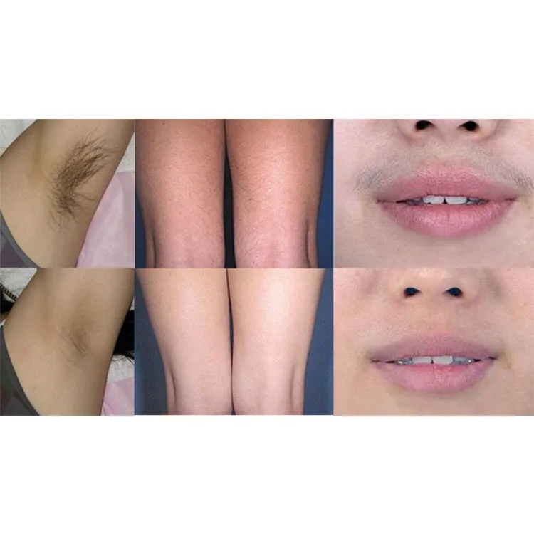 Care Hair Removal Laser Machine Ipl Laser Rf Hair Removal Skin Care Device To Remove Hair Brown