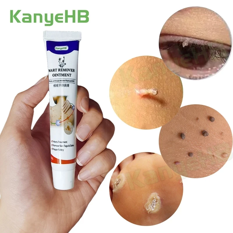 KanyeHB Wart Removal Ointment Treatment Cream Neck Skin Armpit Flat Wart Genitals Feet Corns Medical Wart Cream