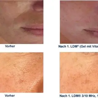 Factory price multifunction IPL machine laser hair removal longest lasting life three years warranty