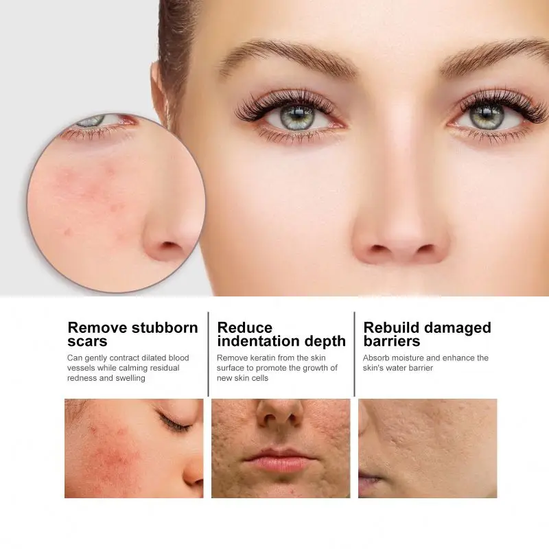EELHOE Nicotinic Acid Facial to Weaken Acne Marks Moisturize Pores Shrink and Whiten Skin Essence