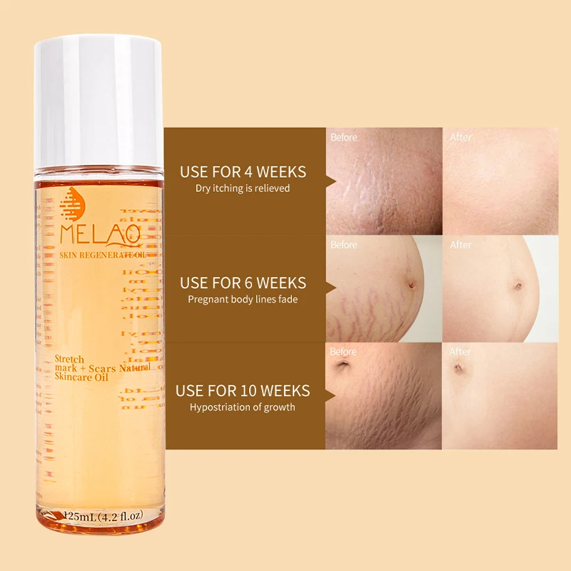 OEM/ODM MELAO Wholesale Stretch Mark Oil Natural Organic Skincare Regenerate Oil Scar Repair Stretch Mark Removal Body Oil