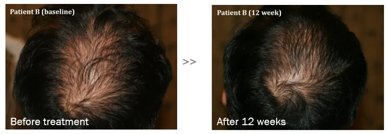 Professional meso therapy peptide hair growth ampoules for hair loss