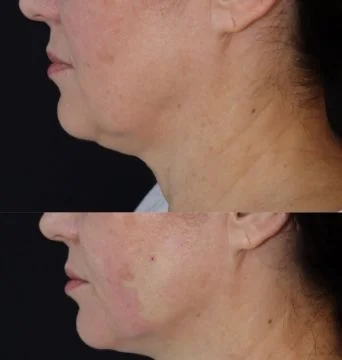 Dual Wavelength Portable 980nm 1470nm Diode Laser Lipolysis and Lipid-lowering Vaser Optical Fiber Endolaser Face Lifting