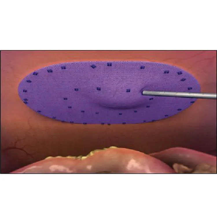 Hernia Repair Mesh Fixation Device Absorbable Tacker For Hernia Laparoscopic Surgery IPOM