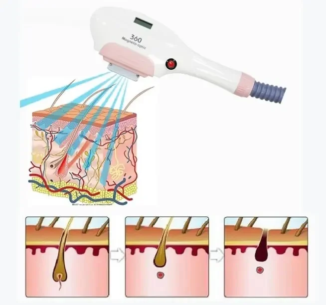 1IPL 360 Magneto / RF / Elight / ND Yag Laser for Black Carbon Wrist Skin Peeling Hair Removal and Tattoo Removal