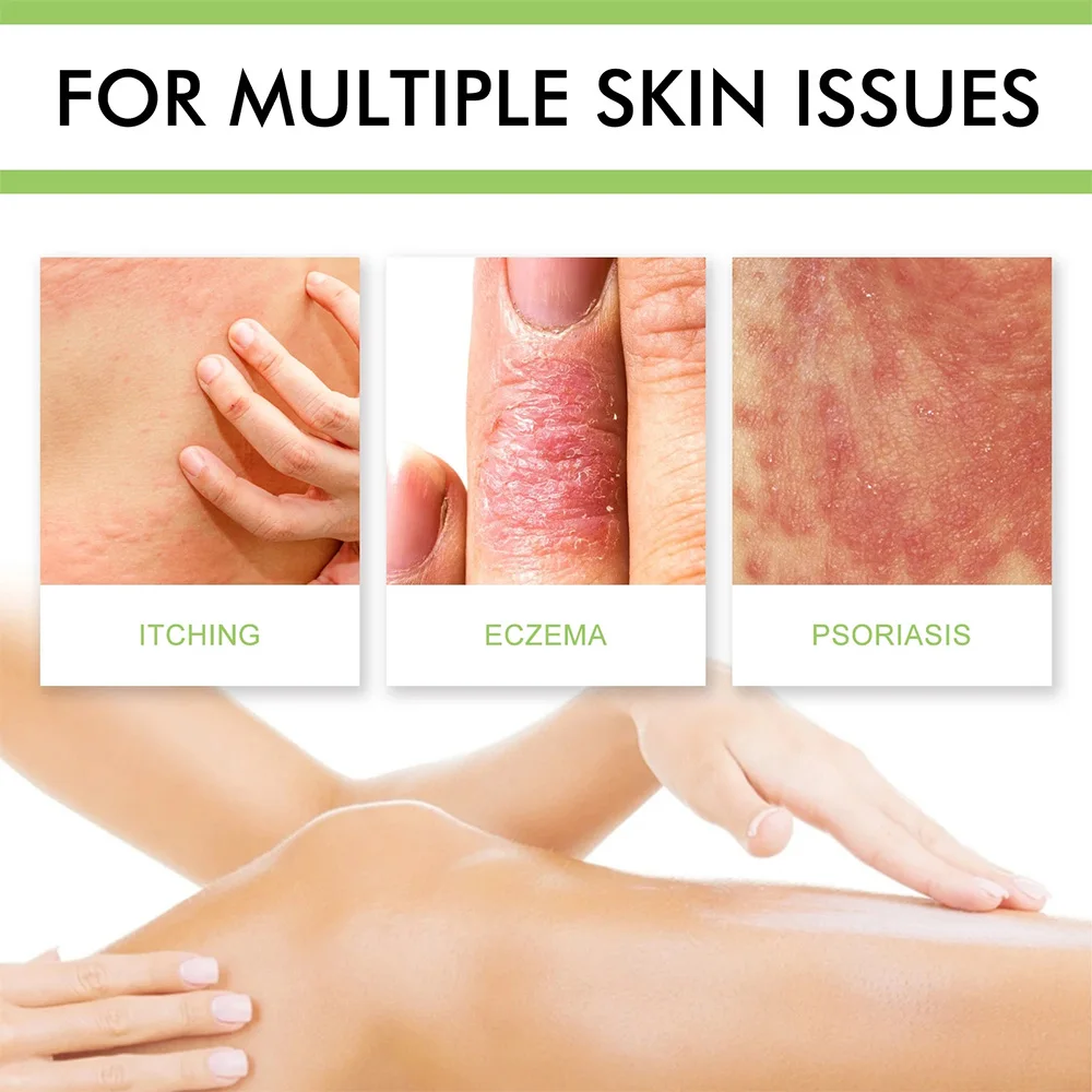 ZB Psoriasis Cream Chinese Herbal Anti-fungel Ointment Dermatitis Eczematoid Eczema Anti-itch Balm 50g