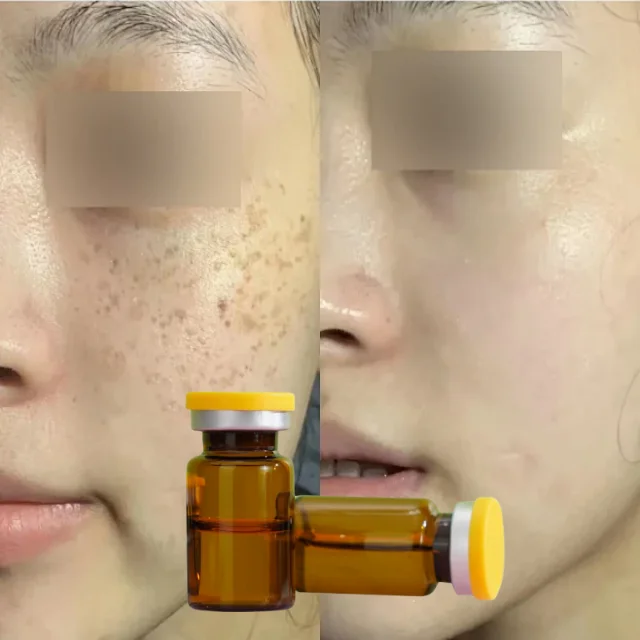Freckle Remover for Skin Whitening Hyperpigmentation Rejuvenating Set Dark Spot Face Mesotherapy Needle