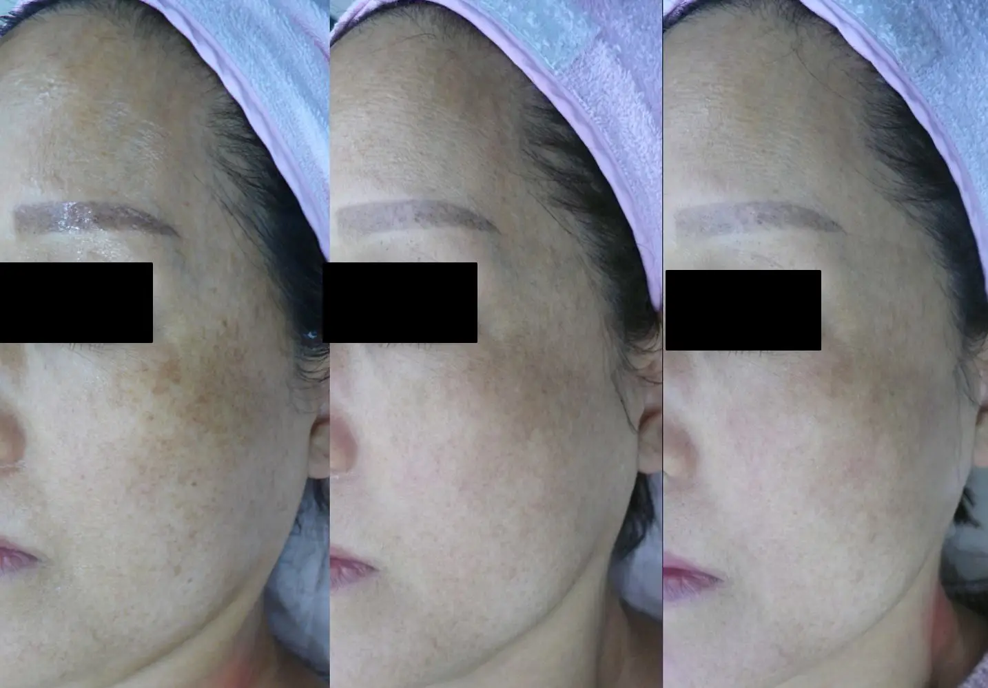 Picosur Laser ND Yag Tatoo Remove Laser Picosecond Pigmentation Removal Machine