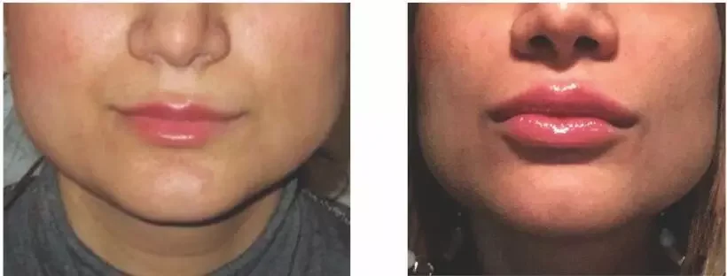 Настраиваемый дермальный наполнитель с гиалуроновой кислотой без иглы инъекционный инжектор для ручки 3-5 мл