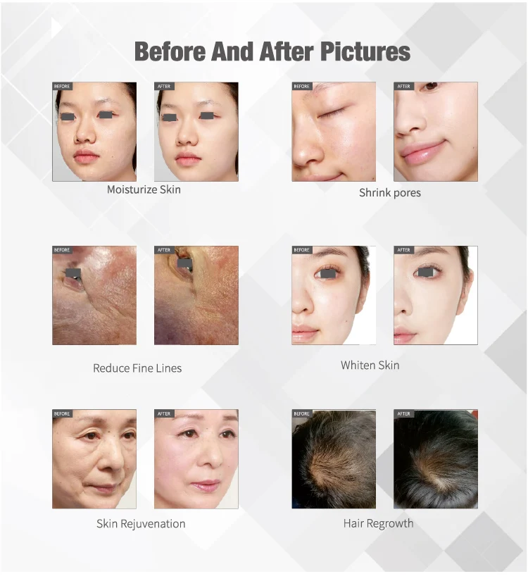 needle-free injection co2 gene oxygen jet machine injection mesotherapy jet peel beauty machine